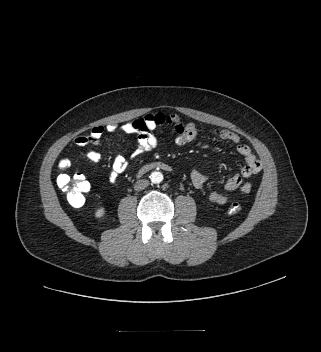 Chromophobe renal cell carcinoma (Radiopaedia 84337-99644 B 59).jpg