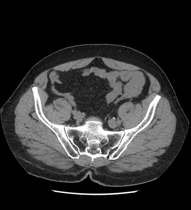 Chromophobe renal cell carcinoma (Radiopaedia 86879-103083 Axial non-contrast 98).jpg