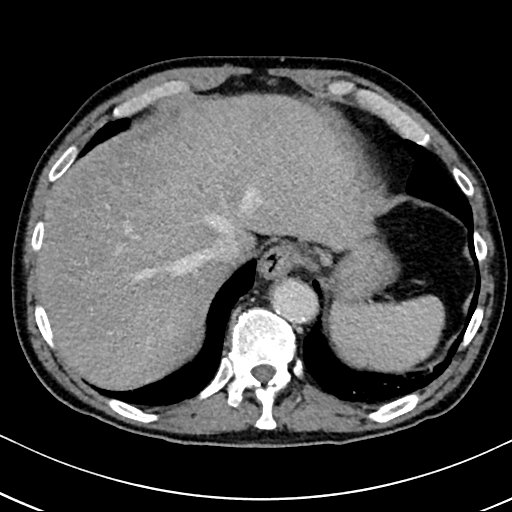 Chronic appendicitis complicated by appendicular abscess, pylephlebitis and liver abscess (Radiopaedia 54483-60700 B 30).jpg