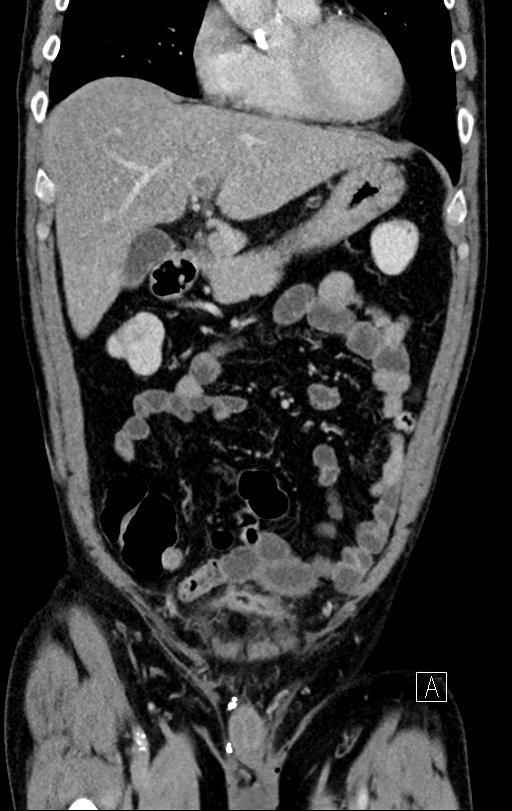 Chronic appendicitis complicated by appendicular abscess, pylephlebitis and liver abscess (Radiopaedia 54483-60700 C 26).jpg