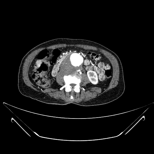 File:Chronic contained rupture of abdominal aortic aneurysm with extensive erosion of the vertebral bodies (Radiopaedia 55450-61901 A 32).jpg
