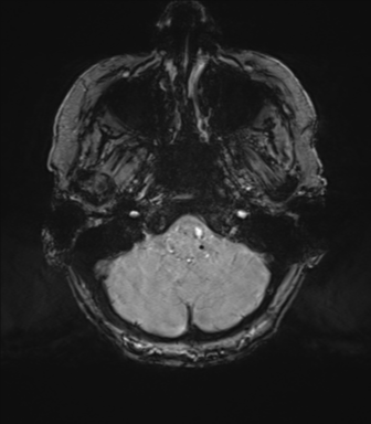 Chronic hypertensive encephalopathy (Radiopaedia 72844-83495 Axial SWI magnitude 12).png