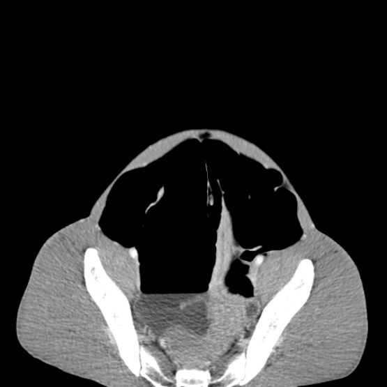 Chronic large bowel pseudo-obstruction (Radiopaedia 43181-46492 A 141).jpg