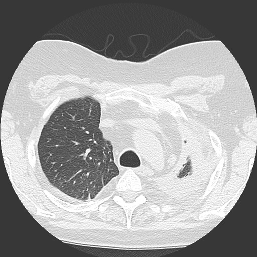 Chronic lung allograft dysfunction - restrictive form (Radiopaedia 60595-68316 Axial lung window 16).jpg