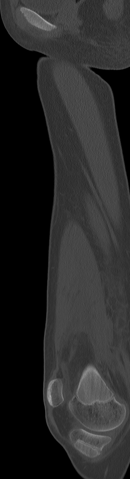 Chronic ostemyelitis of the femur with long sinus tract (Radiopaedia 74947-85982 Sagittal bone window 66).jpg