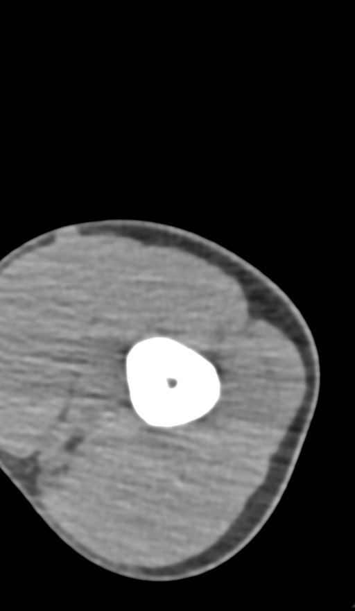 Chronic osteomyelitis of the distal humerus (Radiopaedia 78351-90971 Axial non-contrast 45).jpg