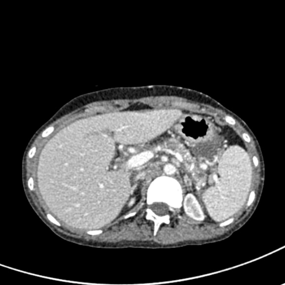 Chronic pancreatitis (Radiopaedia 55405-61846 A 30).jpg