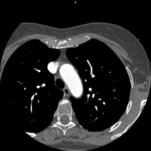 Chronic pulmonary embolism (Radiopaedia 73073-85094 Axial C+ CTPA 22).jpg