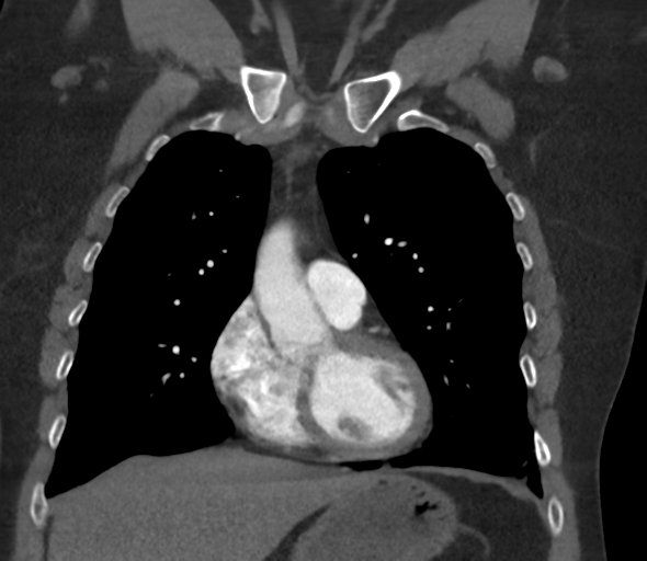 Chronic pulmonary embolus (Radiopaedia 39129-41341 Coronal C+ CTPA 33).png