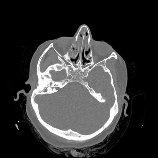 Chronic sinusitis with intra-sinus calcification (Radiopaedia 63919-72668 Axial bone window 27).jpg