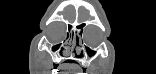 Chronic sphenoidal sinusitis (Radiopaedia 62030-70122 Coronal bone window 35).jpg