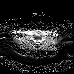 File:Chronic submandibular sialadenitis (Radiopaedia 61852-69885 Axial ADC 24).jpg