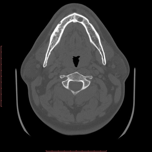 Chronic submandibular sialolithiasis (Radiopaedia 69817-79814 Axial bone window 60).jpg