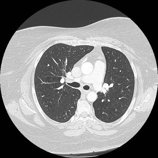 Cicatrisation collapse (Radiopaedia 17405-17089 lung window 46).jpg
