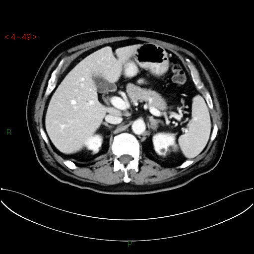 File:Circumaortic left renal vein and doubled left renal arteries (Radiopaedia 52268-58158 B 9).jpg