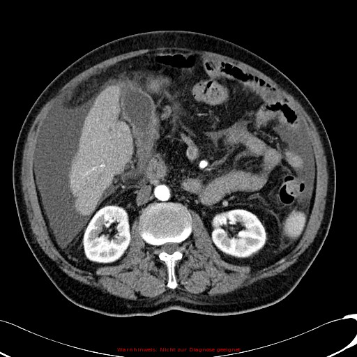File:Cirrhosis and hepatocellular carcinoma in the setting of hemochromatosis (Radiopaedia 75394-86595 A 42).jpg