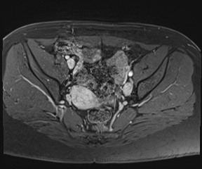 File:Class II Mullerian duct anomaly- unicornuate uterus with rudimentary horn and non-communicating cavity (Radiopaedia 39441-41755 Axial T1 fat sat 50).jpg