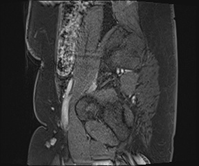 File:Class II Mullerian duct anomaly- unicornuate uterus with rudimentary horn and non-communicating cavity (Radiopaedia 39441-41755 G 112).jpg