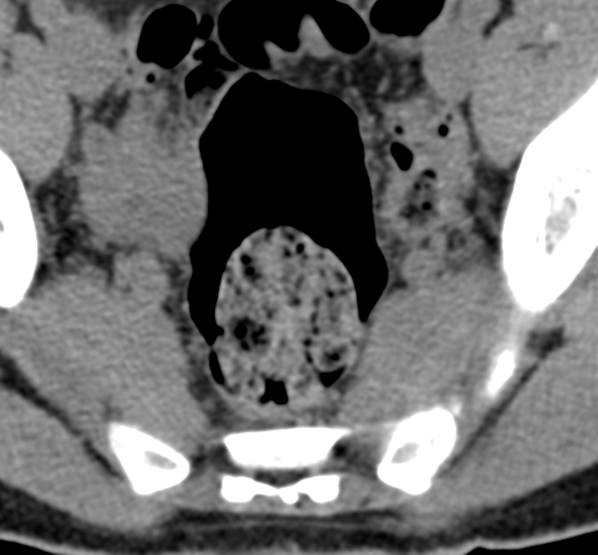 File:Clear cell meningoma - lumbar spine (Radiopaedia 60116-67691 Axial non-contrast 85).png