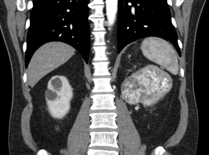 File:Clear cell renal cell carcinoma (Radiopaedia 61449-69393 C 32).jpg