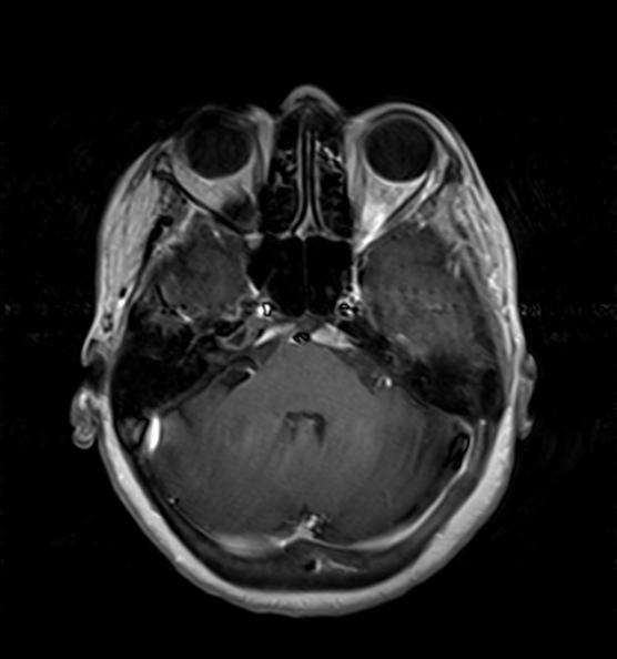 File:Clival meningioma (Radiopaedia 53278-59248 Axial T1 C+ 5).jpg