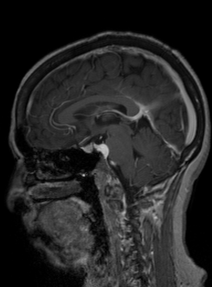 Clival meningioma (Radiopaedia 53278-59248 Sagittal T1 C+ 263).jpg