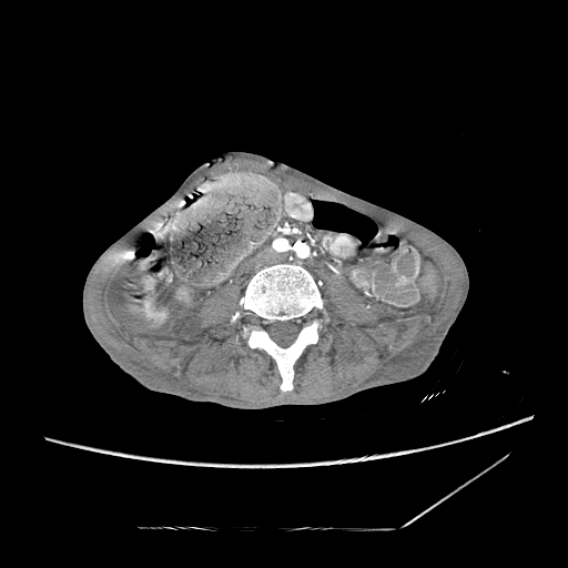 Closed-loop obstruction due to peritoneal seeding mimicking internal hernia after total gastrectomy (Radiopaedia 81897-95864 A 126).jpg