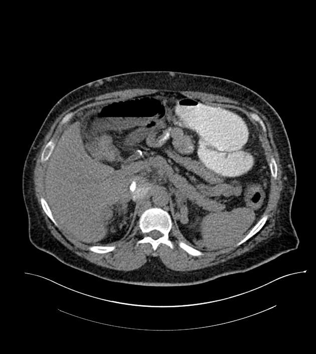 Closed-loop small bowel obstruction-internal hernia (Radiopaedia 78439-91096 Axial non-contrast 43).jpg