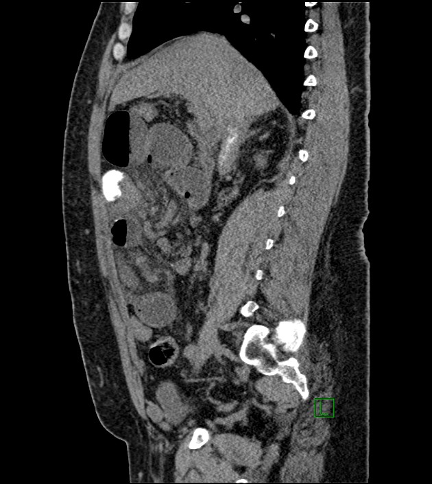 Closed-loop small bowel obstruction-internal hernia (Radiopaedia 78439-91096 C 89).jpg
