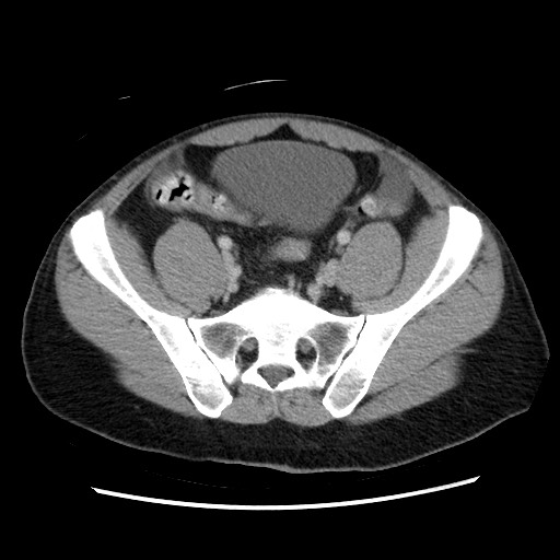 Closed-loop small bowel obstruction (Radiopaedia 73713-84509 A 127).jpg