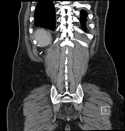 File:Closed loop obstruction - internal hernia into nephrectomy bed (Radiopaedia 59867-67320 B 123).jpg