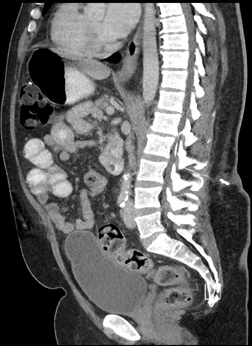 Closed loop obstruction - internal hernia into nephrectomy bed (Radiopaedia 59867-67320 C 46).jpg