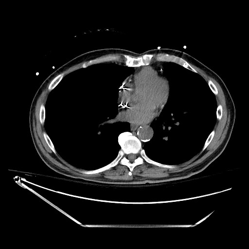 Closed loop obstruction due to adhesive band, resulting in small bowel ischemia and resection (Radiopaedia 83835-99023 Axial non-contrast 4).jpg