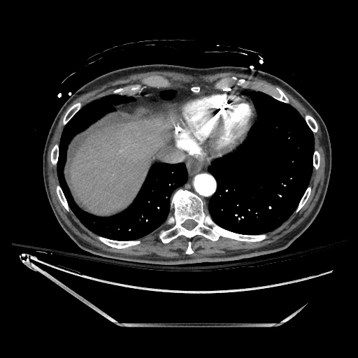 File:Closed loop obstruction due to adhesive band, resulting in small bowel ischemia and resection (Radiopaedia 83835-99023 B 19).jpg
