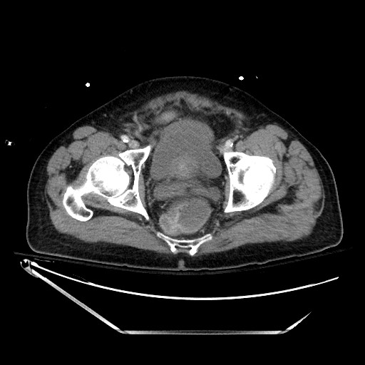 File:Closed loop obstruction due to adhesive band, resulting in small bowel ischemia and resection (Radiopaedia 83835-99023 D 143).jpg