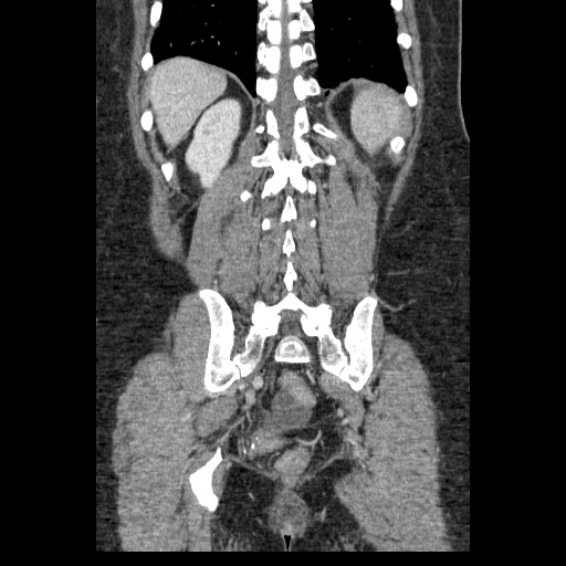 File:Closed loop small bowel obstruction (Radiopaedia 65403-74451 B 83).jpg
