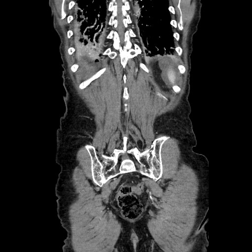 Closed loop small bowel obstruction - adhesive disease and hemorrhagic ischemia (Radiopaedia 86831-102990 B 109).jpg