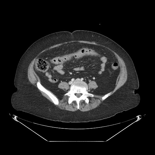 Closed loop small bowel obstruction - internal hernia (Radiopaedia 65402-74450 A 83).jpg