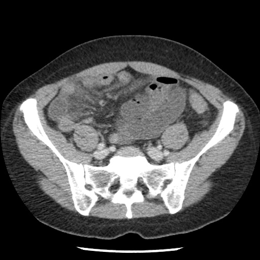 File:Closed loop small bowel obstruction due to trans-omental herniation (Radiopaedia 35593-37109 A 63).jpg
