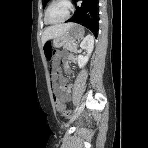 File:Closed loop small bowel obstruction due to trans-omental herniation (Radiopaedia 35593-37109 C 43).jpg