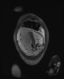 File:Closed loop small bowel obstruction in pregnancy (MRI) (Radiopaedia 87637-104031 Coronal T2 fat sat 13).jpg
