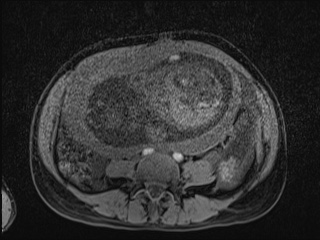 Closed loop small bowel obstruction in pregnancy (MRI) (Radiopaedia 87637-104031 F 19).jpg