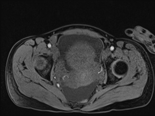 Closed loop small bowel obstruction in pregnancy (MRI) (Radiopaedia 87637-104031 G 13).jpg