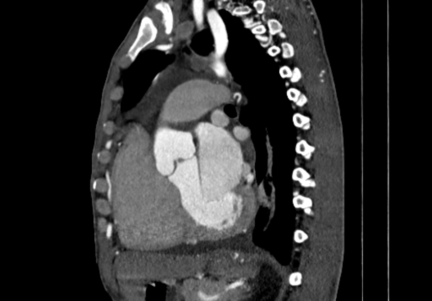 Coarctation of aorta with aortic valve stenosis (Radiopaedia 70463-80574 B 89).jpg
