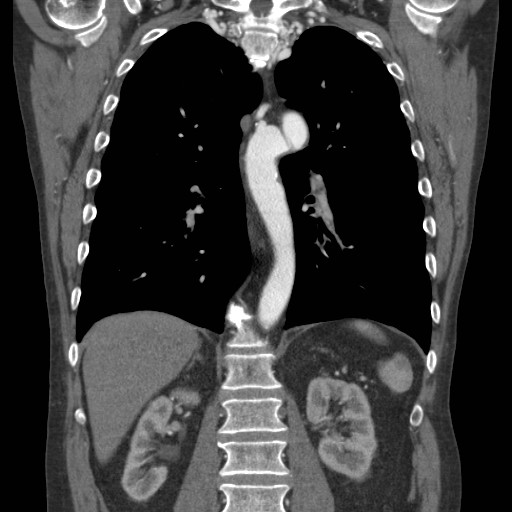 Coarctation of the aorta (Radiopaedia 17427-17116 A 35).jpg