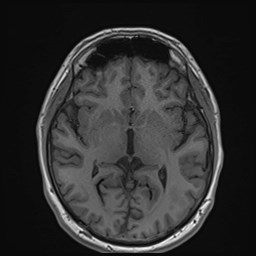 File:Cochlear incomplete partition type III associated with hypothalamic hamartoma (Radiopaedia 88756-105498 Axial T1 101).jpg