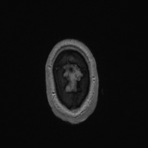 Colloid cyst (Radiopaedia 44510-48181 Axial T1 C+ 170).png