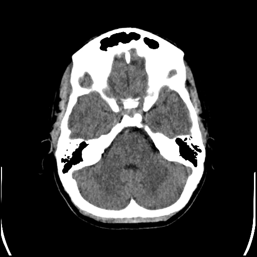 File:Colloid cyst (Radiopaedia 78104-90633 Axial non-contrast 28).jpg