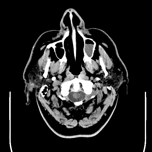 File:Colloid cyst (large) (Radiopaedia 34415-35734 Axial non-contrast 6).png