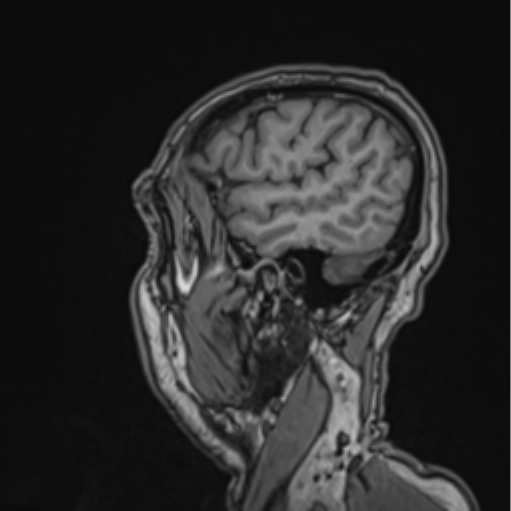 File:Colloid cyst of the third ventricle (Radiopaedia 86571-102662 Sagittal T1 65).png